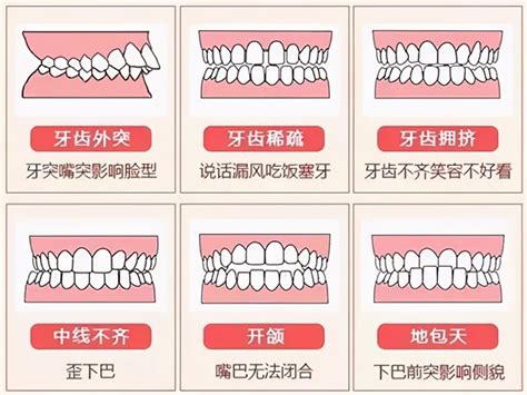 门牙|什么是门牙